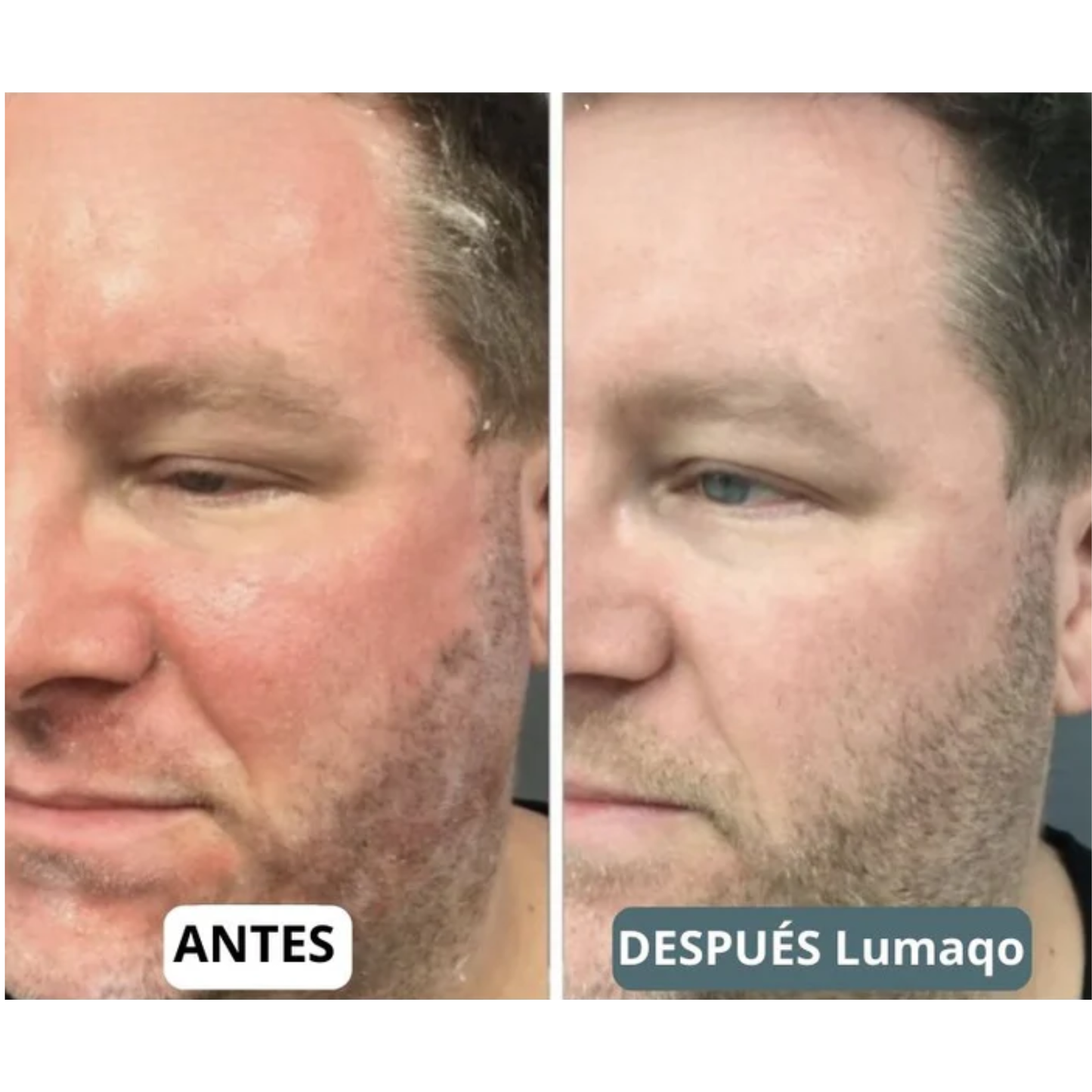 DermaCalma™ Pro+ | Barba y Cuero Cabelludo Calmados